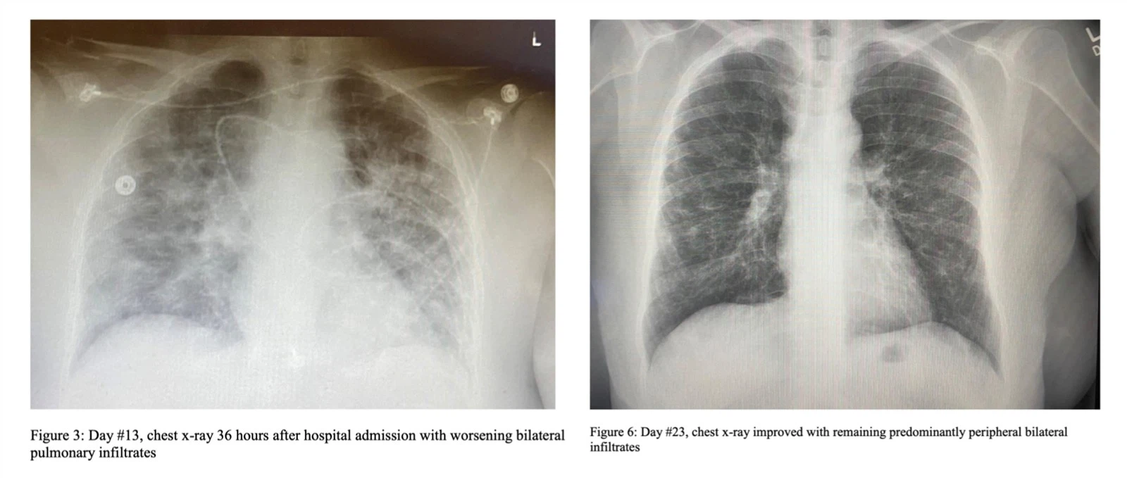 After receiving NMN cocktail therapy (right), the patient's lung condition improved significantly